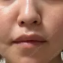 鼻翼基部形成（貴族手術） / ヒアルロン酸注入（鼻） / ボトックス（口角） / ボトックス（人中） eクリニック 名古屋院 DAY 34 サムネイル用