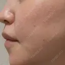 鼻翼基部形成（貴族手術） / ヒアルロン酸注入（鼻） / ボトックス（口角） / ボトックス（人中） eクリニック 名古屋院 DAY 34 サムネイル用