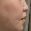 鼻翼基部形成（貴族手術） / ヒアルロン酸注入（鼻） / ボトックス（口角） / ボトックス（人中） eクリニック 名古屋院 DAY 34 サムネイル用