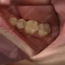 セラミック / その他（審美歯科/矯正歯科） 東京美容外科 赤坂院 AFTER サムネイル用