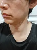 ルメッカ ルラ美容クリニック 名古屋本院 DAY 9 サムネイル用
