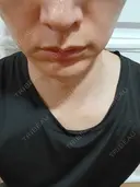 ルメッカ ルラ美容クリニック 名古屋本院 DAY 9 サムネイル用