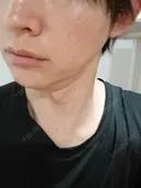 ルメッカ ルラ美容クリニック 名古屋本院 DAY 10 サムネイル用