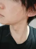 ルメッカ ルラ美容クリニック 名古屋本院 DAY 10 サムネイル用