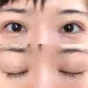 二重切開 / 目元修正 ルネッサンス美容外科医院 神戸院 DAY 140 サムネイル用