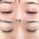 二重切開 / 目元修正 ルネッサンス美容外科医院 神戸院 DAY 140 サムネイル用