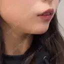 ボトックス（あご） / ヒアルロン酸注入（あご） / ボトックス（エラ・小顔） TCB東京中央美容外科 静岡院 DAY 0 サムネイル用