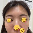 ボトックス（目尻） TCB東京中央美容外科 町田院 DAY 1 サムネイル用