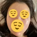 額を丸く / 下まぶたの脂肪取り / 脂肪注入（額） / 脂肪注入（目の下） イテウォンビューティークリニック 名古屋栄院 DAY 10 サムネイル用
