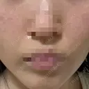 ポテンツァ ルラ美容クリニック 岡山院 DAY 6 サムネイル用