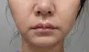 糸リフト / ボトックス（眉間） / ボトックス（額） アリエル美容クリニック 大宮院 DAY 14 サムネイル用