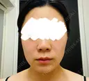 脂肪吸引（顔） / 脂肪吸引（二の腕） Mods Clinic（モッズクリニック） 福岡院 DAY 183 サムネイル用