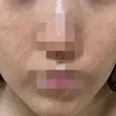 ポテンツァ ルラ美容クリニック 岡山院 DAY 7 サムネイル用