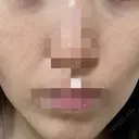 ポテンツァ ルラ美容クリニック 岡山院 DAY 8 サムネイル用