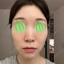 エレクトロポレーション / ピコレーザートーニング（美白・肝斑） 東京美容クリニック 表参道本院 DAY 1 サムネイル用