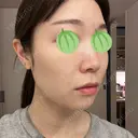 エレクトロポレーション / ピコレーザートーニング（美白・肝斑） 東京美容クリニック 表参道本院 DAY 1 サムネイル用