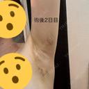 ワキ汗治療（ボトックス） / ワキ汗治療（レーザー） ルラ美容クリニック 渋谷本院 DAY 0 サムネイル用