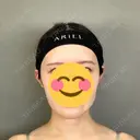 糸リフト / バッカルファット除去 / 脂肪吸引（顔） / ボトックス（エラ・小顔） アリエル美容クリニック 大宮院 AFTER サムネイル用