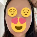 額を丸く / 下まぶたの脂肪取り / 脂肪注入（額） / 脂肪注入（目の下） イテウォンビューティークリニック 名古屋栄院 DAY 12 サムネイル用