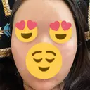 額を丸く / 下まぶたの脂肪取り / 脂肪注入（額） / 脂肪注入（目の下） イテウォンビューティークリニック 名古屋栄院 DAY 13 サムネイル用