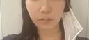 脂肪溶解注射（顔） Nクリニック伏見 DAY 1 サムネイル用