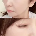 肌ヒアルロン酸注入（たるみ・シワ改善） / ボトックス（眉間） / ボトックス（目尻） ルラ美容クリニック 大宮院 / ルラスキンクリニック 大宮院 DAY 0 サムネイル用