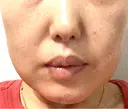 糸リフト / バッカルファット除去 / 脂肪吸引（顔） / ジョールファット除去 / ヒアルロン酸注入（あご） THE FIRST CLINIC 多摩センター院 AFTER サムネイル用