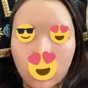 額を丸く / 下まぶたの脂肪取り / 脂肪注入（額） / 脂肪注入（目の下） イテウォンビューティークリニック 名古屋栄院 DAY 13 サムネイル用