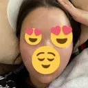 額を丸く / 下まぶたの脂肪取り / 脂肪注入（額） / 脂肪注入（目の下） イテウォンビューティークリニック 名古屋栄院 AFTER サムネイル用