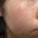 ピコレーザートーニング（美白・肝斑） Grias clinic （ジリアスクリニック） DAY 1 サムネイル用