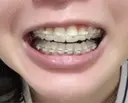 矯正（ワイヤー） X CLINIC 銀座院 DAY 80 サムネイル用