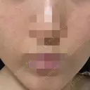 ポテンツァ ルラ美容クリニック 岡山院 DAY 10 サムネイル用