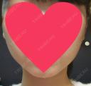 ハイフ（顔） 赤坂プレミアクリニック DAY 13 サムネイル用
