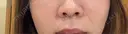 ヒアルロン酸注入（鼻翼基部） 大美会クリニック 梅田院 AFTER サムネイル用