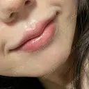 ヒアルロン酸注入（唇） / ボトックス（口角） ルラ美容クリニック 仙台院 / ルラスキンクリニック 仙台院 AFTER サムネイル用