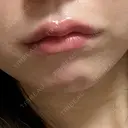 ヒアルロン酸注入（唇） / ボトックス（口角） ルラ美容クリニック 仙台院 / ルラスキンクリニック 仙台院 DAY 1 サムネイル用