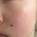 ピコレーザートーニング（美白・肝斑） Grias clinic （ジリアスクリニック） DAY 3 サムネイル用