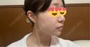糸リフト アリエル美容クリニック 郡山院 AFTER サムネイル用