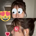 隆鼻術 / 鼻尖形成（切開） / 鼻中隔延長（切開） / 軟骨移植 THE ROPPONGI CLINIC（ザ 六本木クリニック） DAY 33 サムネイル用
