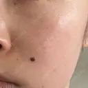 ピコレーザートーニング（美白・肝斑） Grias clinic （ジリアスクリニック） DAY 4 サムネイル用