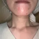 ピーリング（ニキビ・毛穴） / 光治療（フォトフェイシャルなど） RAISE CLINIC 【レイズクリニック】 AFTER サムネイル用