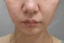 糸リフト / ボトックス（眉間） / ボトックス（額） アリエル美容クリニック 大宮院 DAY 21 サムネイル用