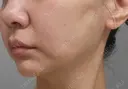 糸リフト / ボトックス（眉間） / ボトックス（額） アリエル美容クリニック 大宮院 DAY 21 サムネイル用