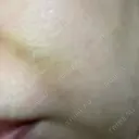 ショッピングリフト BAO CLINIC 梅田院 DAY 4 サムネイル用