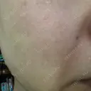 ショッピングリフト BAO CLINIC 梅田院 DAY 4 サムネイル用