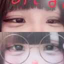 二重埋没 R Beauty CLINIC 銀座院 AFTER サムネイル用