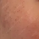 ピーリング（ニキビ・毛穴） / ルメッカ ルラ美容クリニック 大宮院 / ルラスキンクリニック 大宮院 DAY 0 サムネイル用