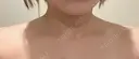 ボトックス（肩） 共立美容外科 大阪本院 AFTER サムネイル用