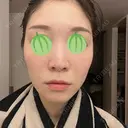 エレクトロポレーション / ピコレーザートーニング（美白・肝斑） 東京美容クリニック 表参道本院 AFTER サムネイル用