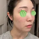 エレクトロポレーション / ピコレーザートーニング（美白・肝斑） 東京美容クリニック 表参道本院 DAY 8 サムネイル用